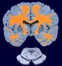 cerebro con esclerosis