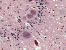 placas amiloides