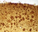 placas beta amiloide